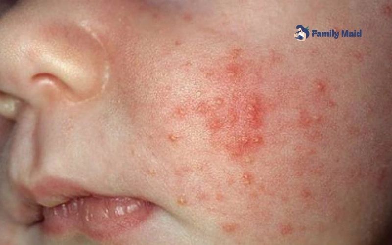 Mụn kê ở trẻ sơ sinh