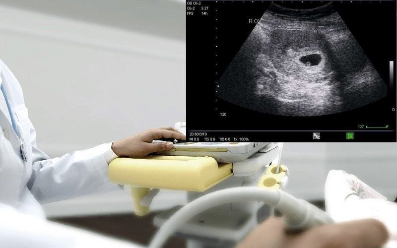 Mẹ bầu nên theo dõi kích thước, vị trí túi thai và tim thai để đảm bảo thai kỳ an toàn và phát triển khỏe mạnh Mẹ bầu nên theo dõi kích thước, vị trí túi thai và tim thai để đảm bảo thai kỳ an toàn và phát triển khỏe mạnh