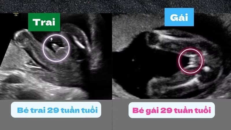 Góc nghiêng lao sinh dục giúp dự đoán giới tính sớm nhưng độ chính xác còn hạn chế Góc nghiêng lao sinh dục giúp dự đoán giới tính sớm nhưng độ chính xác còn hạn chế