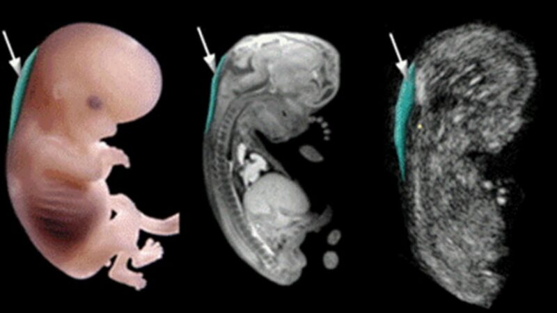 Siêu âm 5D giúp quan sát vùng gáy thai nhi