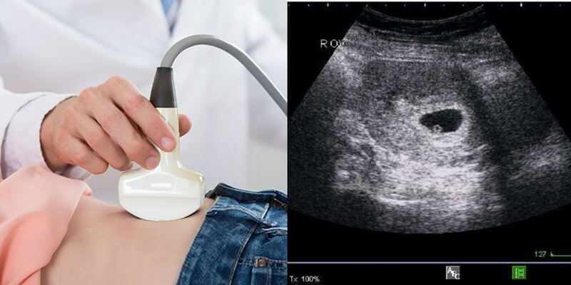 Siêu âm bụng thường chưa cho hình ảnh rõ ở giai đoạn thai 4 tuần do phôi thai còn rất nhỏ Siêu âm bụng thường chưa cho hình ảnh rõ ở giai đoạn thai 4 tuần do phôi thai còn rất nhỏ