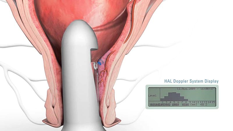Siêu âm đầu dò giúp quan sát thai 7 tuần rõ ràng và chính xác hơn